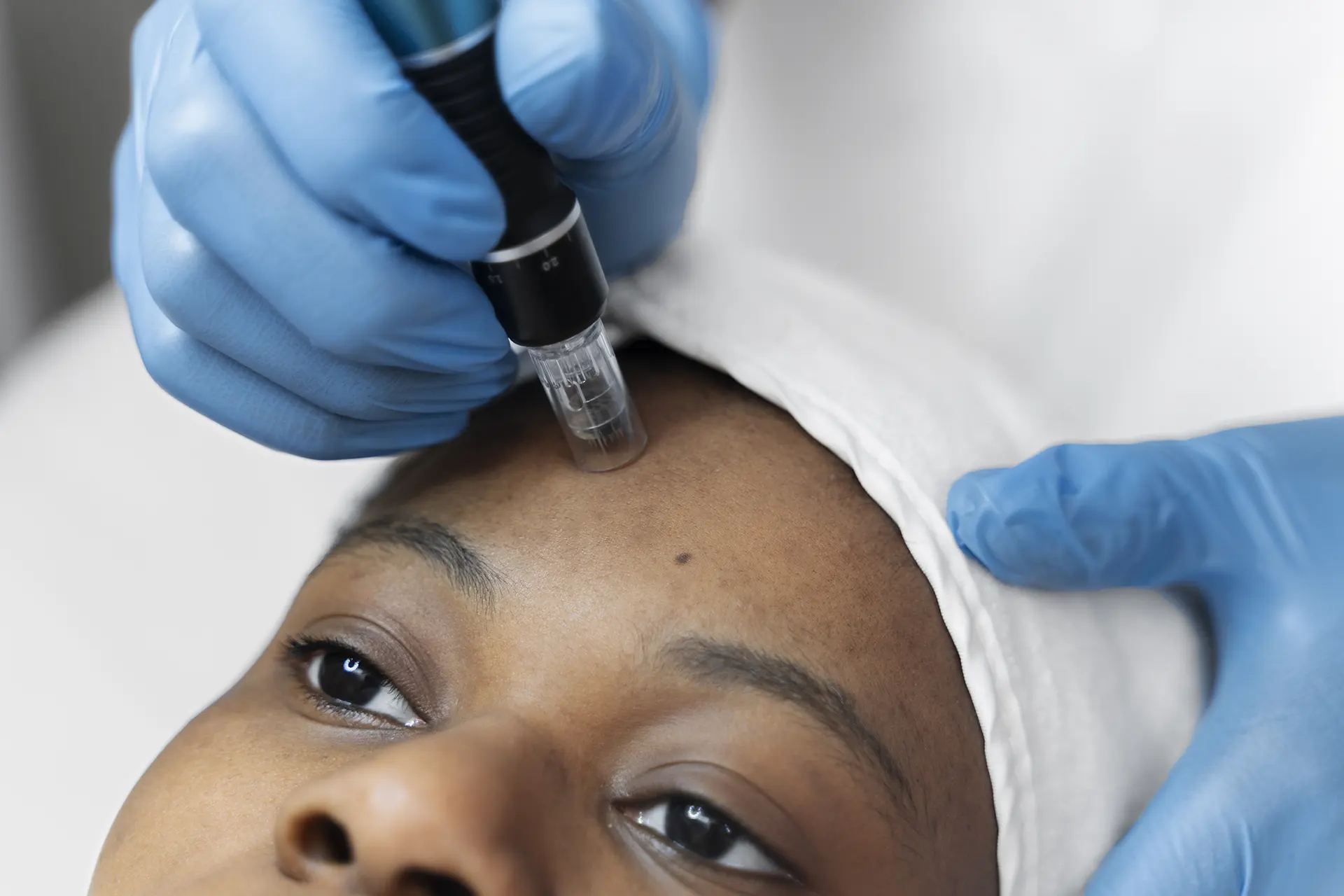 microneedling-lozan-beauty-spa-landstuhl